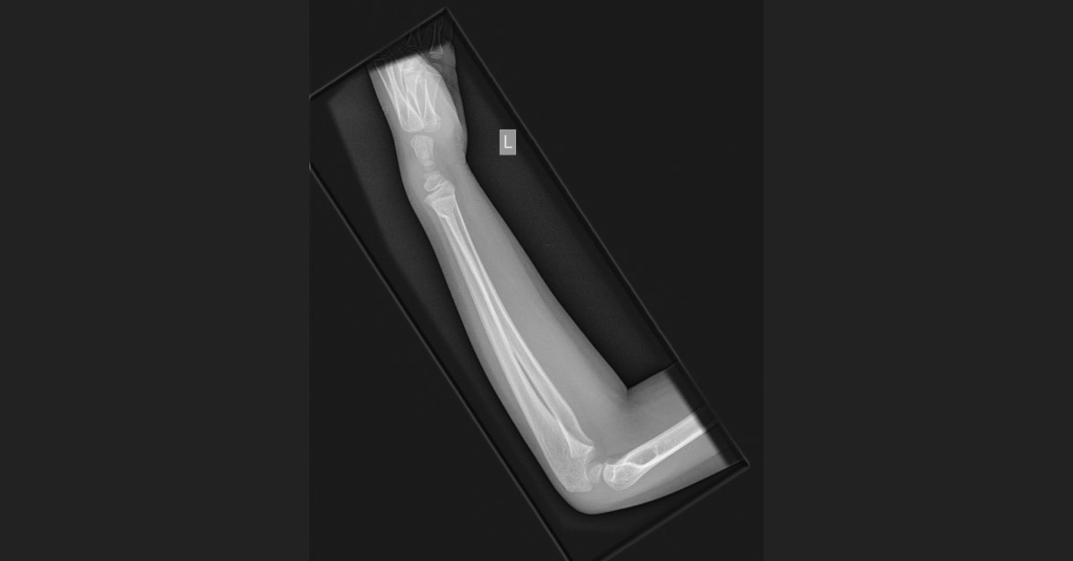 A Boy with Trauma After Falling on the Hand