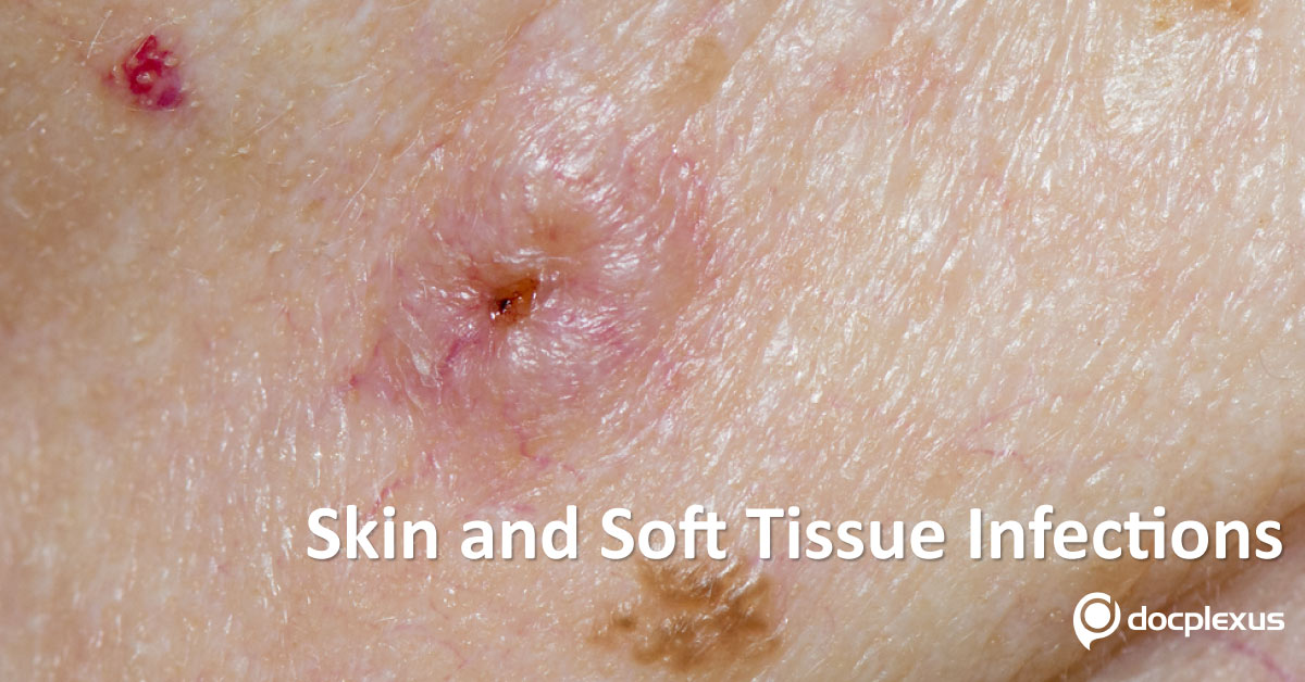 Treatment of MRSA Skin and Soft Tissue Infections