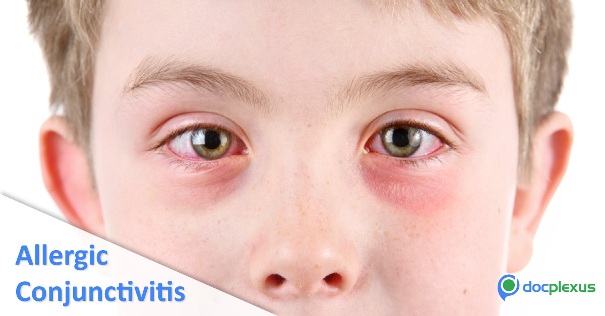 Allergic Conjunctivitis And Cytokine Related Genetic Polymorphisms