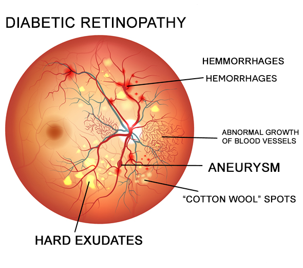How Often Should A Diabetic Patient See Ophthalmologist