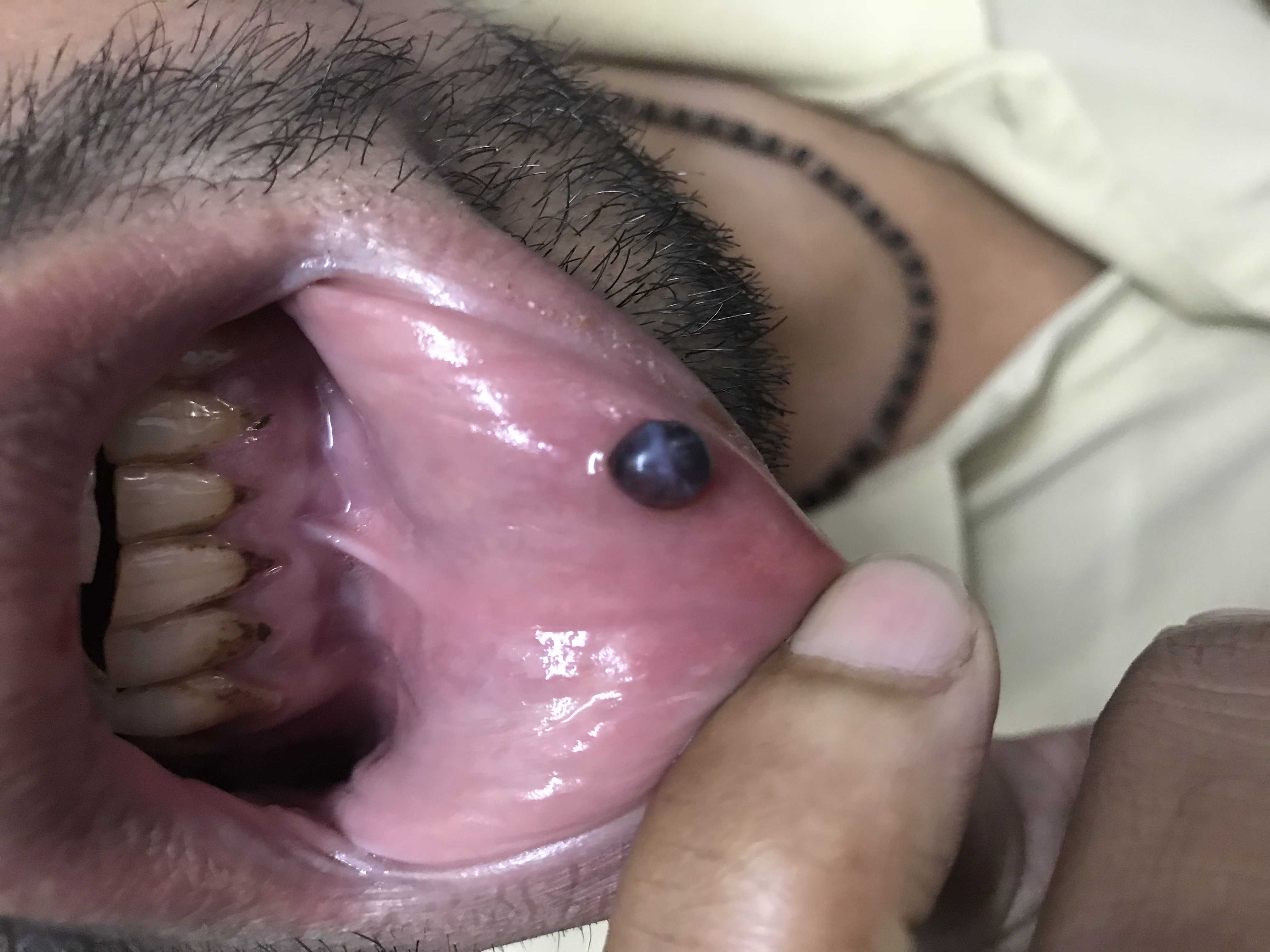 What Can Be This Lesion?