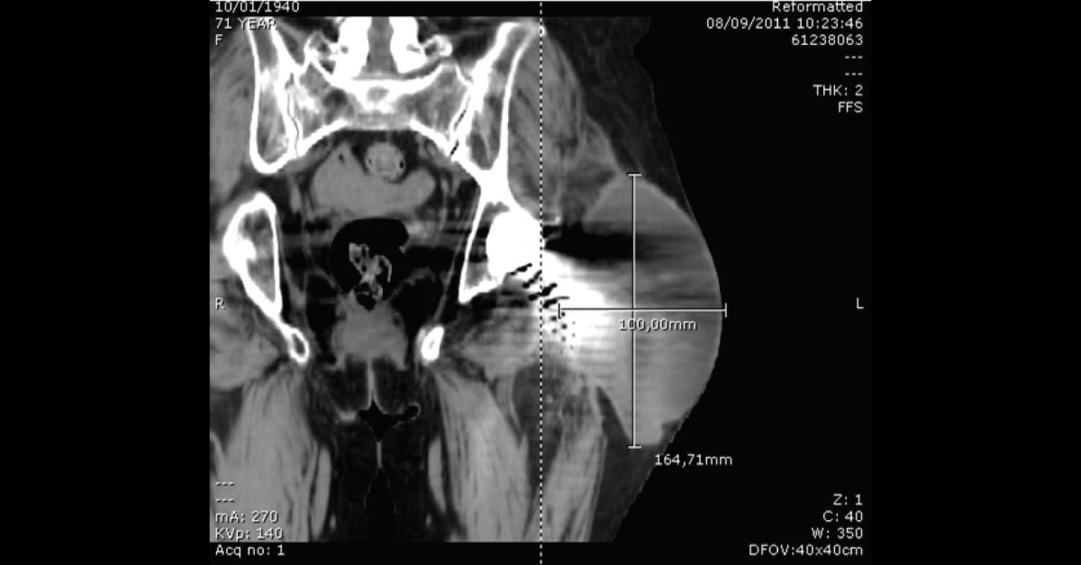 Case Of Swelling Of Hip Joint After Arthroplasty