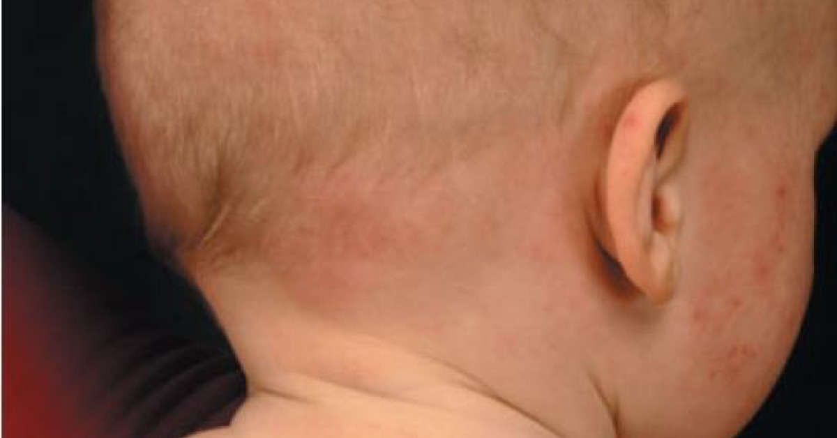 An Infant With Rash