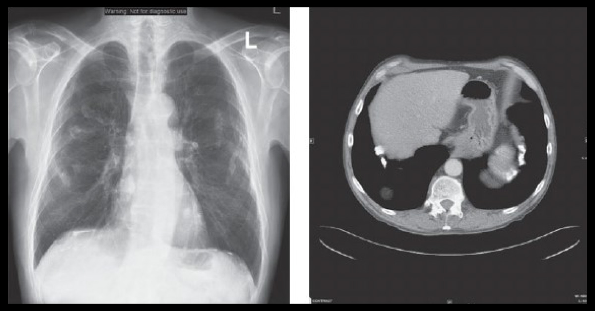 A Retired Construction Worker with Cough and a History of Hernia Repair
