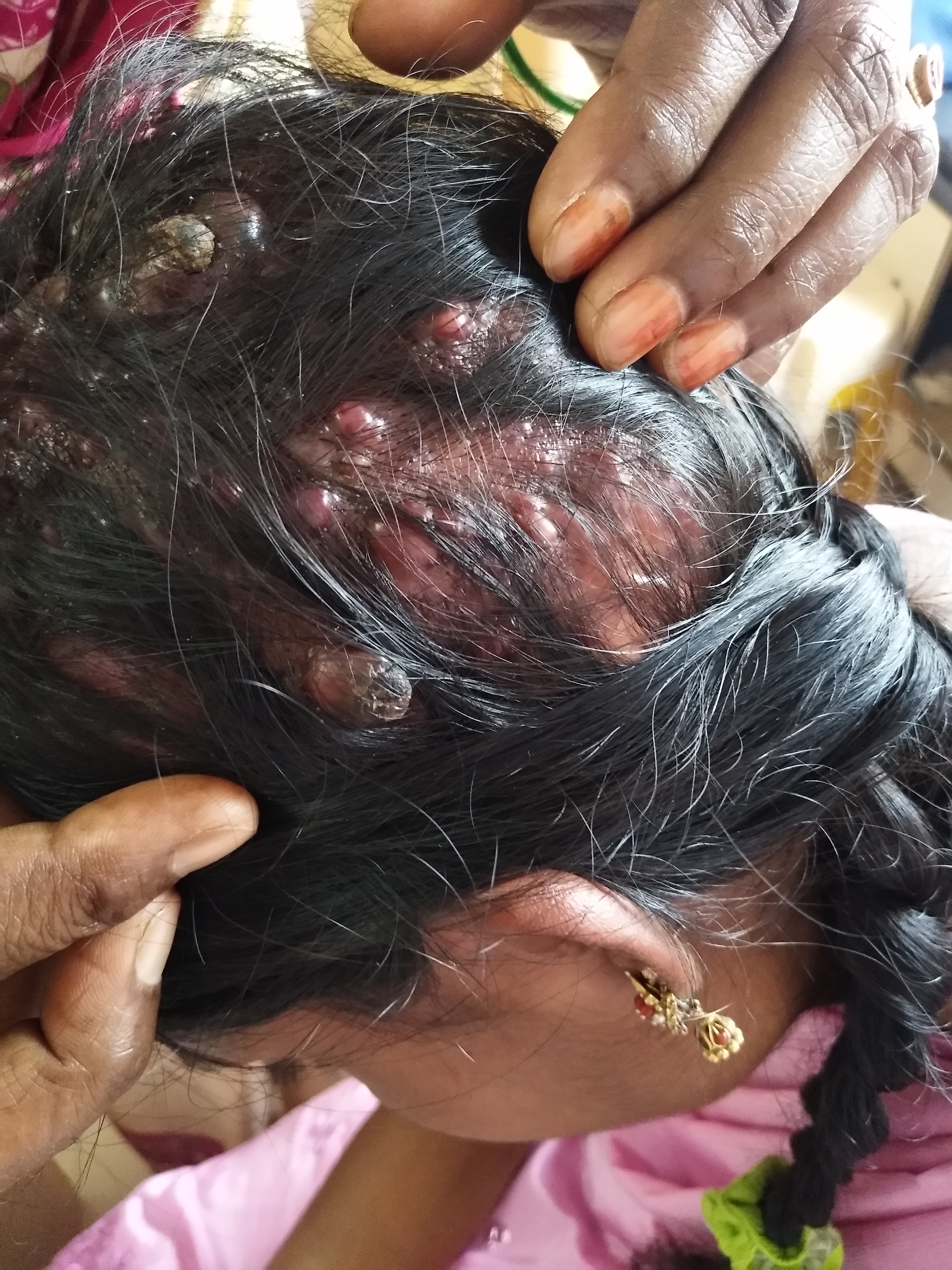 Papulo-Nodular Lesions On Scalp