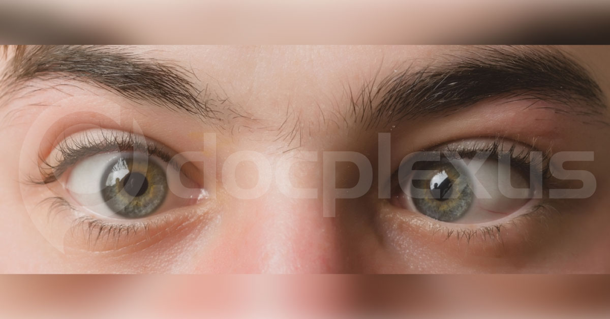 Squint Surgery