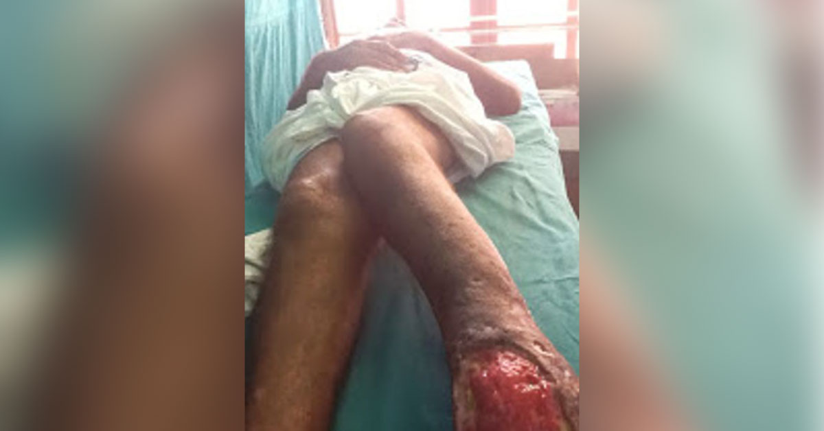 How To Treat This Chronic Leg Ulcer?