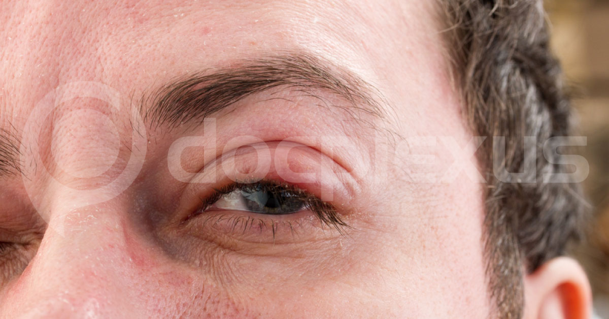 Brief Review On The Status Of Trachoma In Present Days Ophthalmology