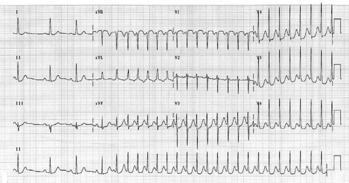 Sudden Palpitations in a Geriatric Patient