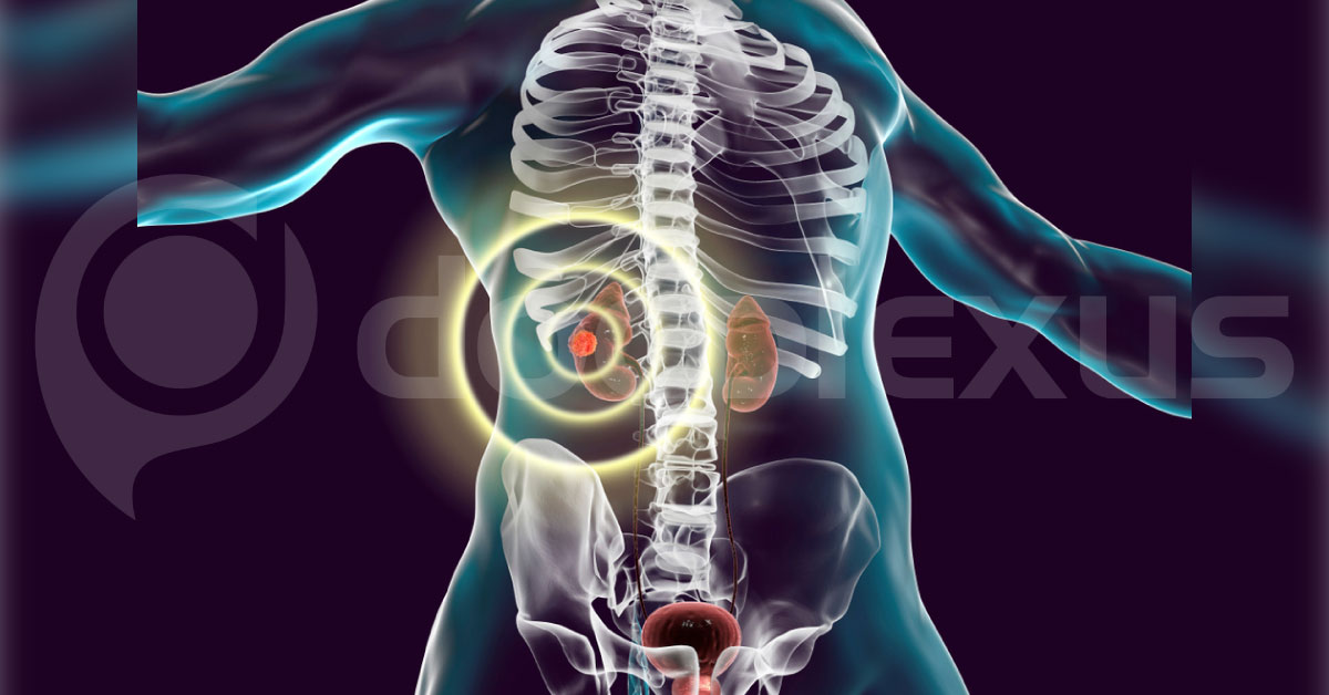 New Radiotherapy Drug To Treat Pheochromocytoma & ParagangliomaTumors