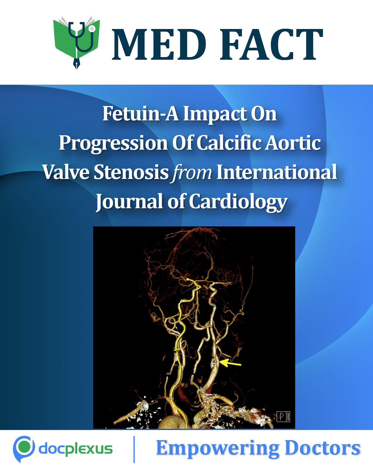Impact Of Fetuin-A On Progression Of Calcific Aortic Valve Stenosis