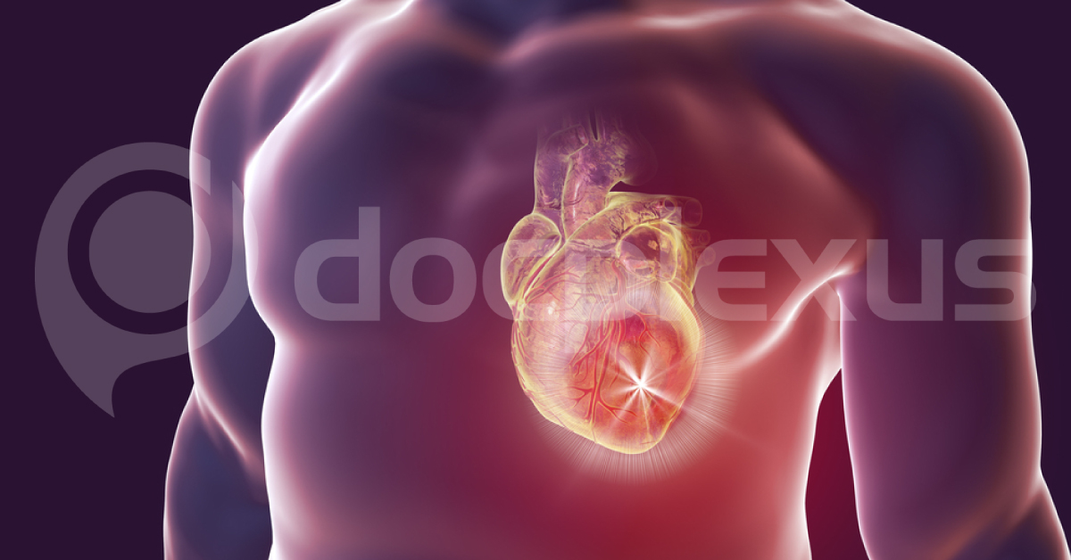CULPRIT-Shock Trial and ESC STEMI Guidelines