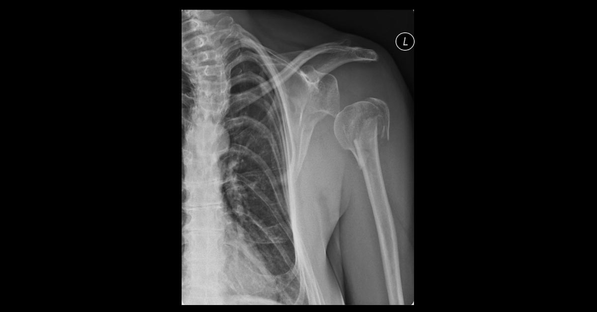 Female With Right Shoulder Trauma