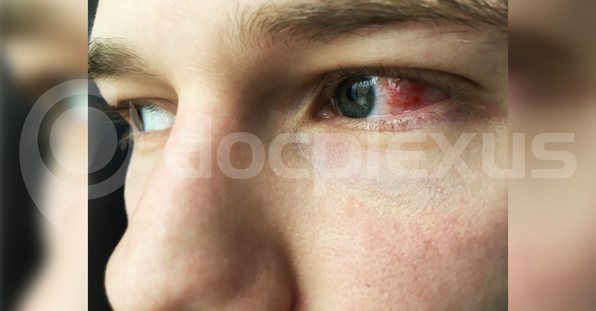 Current Status Of Sympathetic Ophthalmia