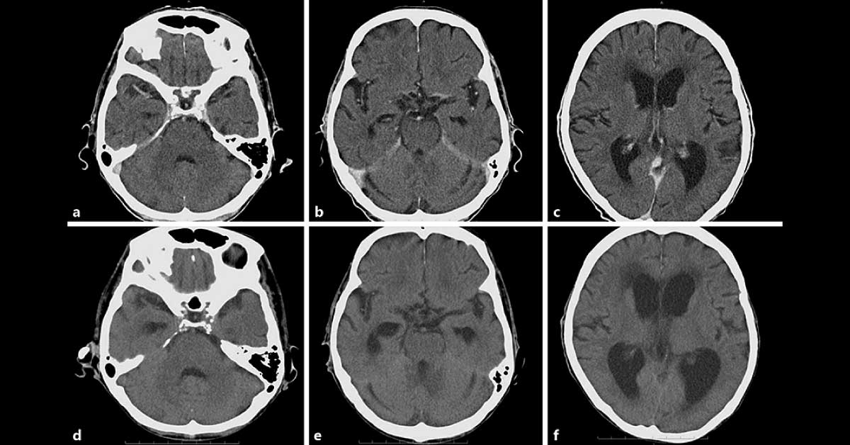 Gastric Cancer Patient With Worsening Fever And Delirium