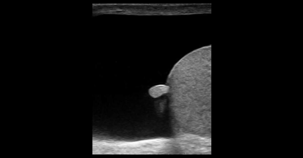 Scrotal Swelling In A Male