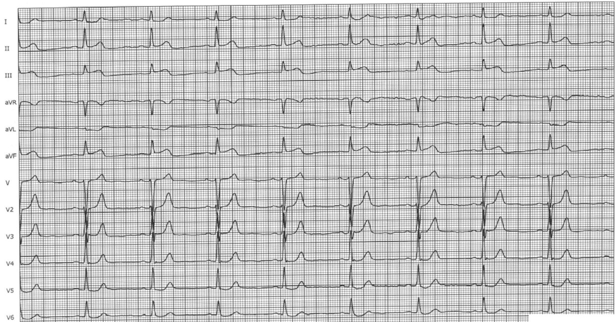 Spot This Cardiac Abnormality