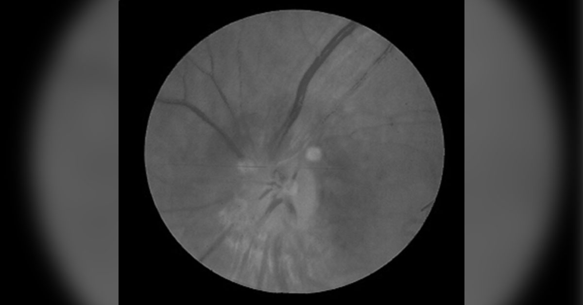 A Lady with Severe Headache and Reduced Vision