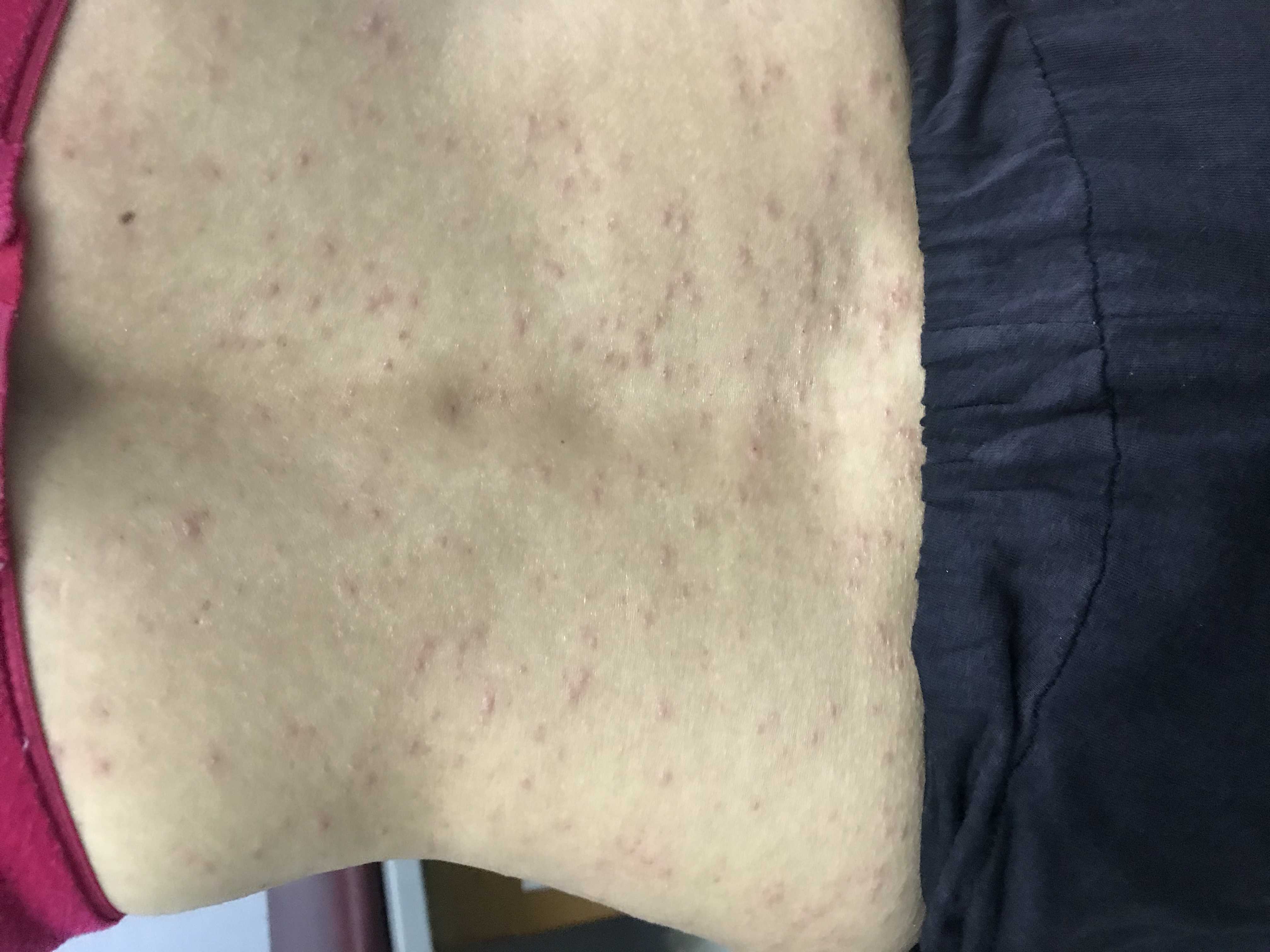 What is this skin condition causing intense itching?