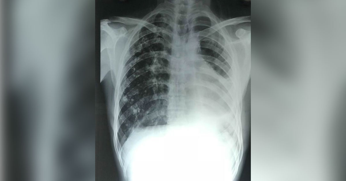 Why Pain In Chest On Lt Side?
