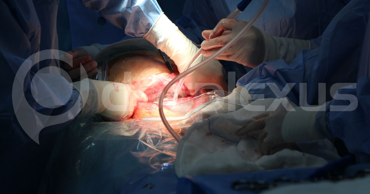 Pain After Surgery Depends On Incision Length After C-Section