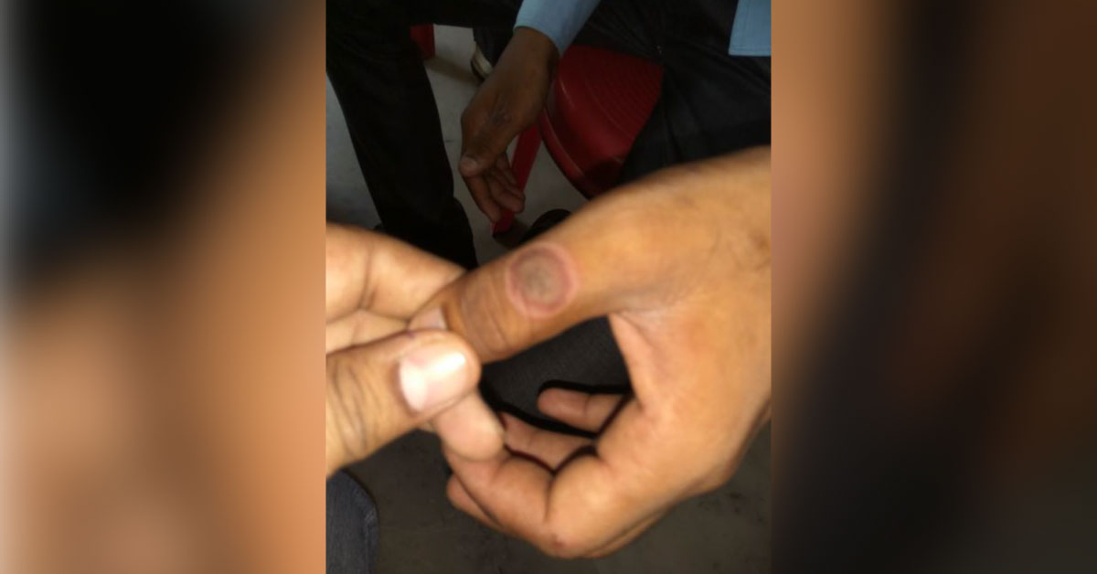 Diagnose These Blisters On Upper And Lower Limb
