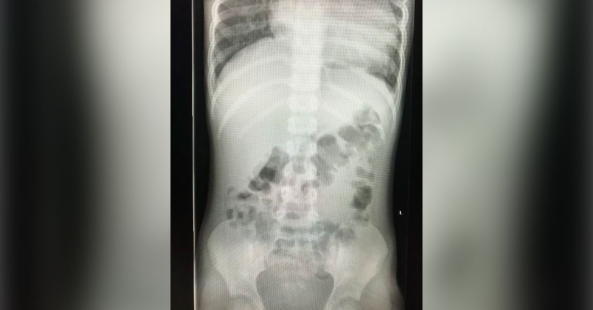 Further Diagnosis Of Abdominal Pain