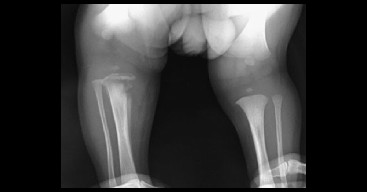 Case of a Restless Neonate -  What's Your Diagnosis?