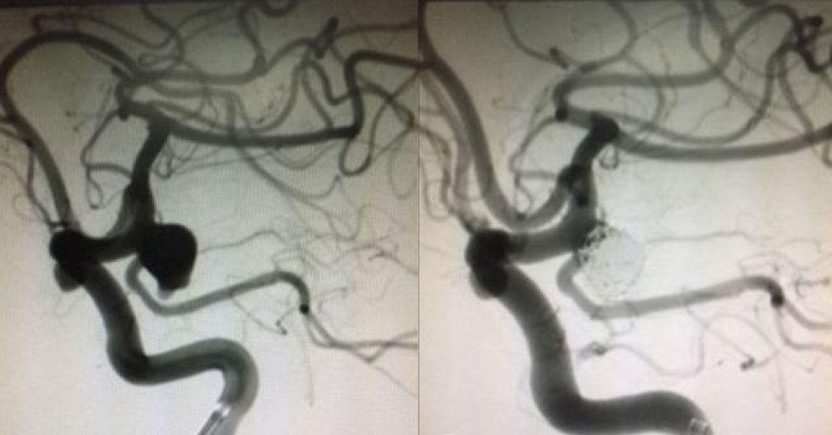 Management Of Posterior Communicating Artery Aneurysm In The Presence Of Fetal Posterior Cerebral Artery