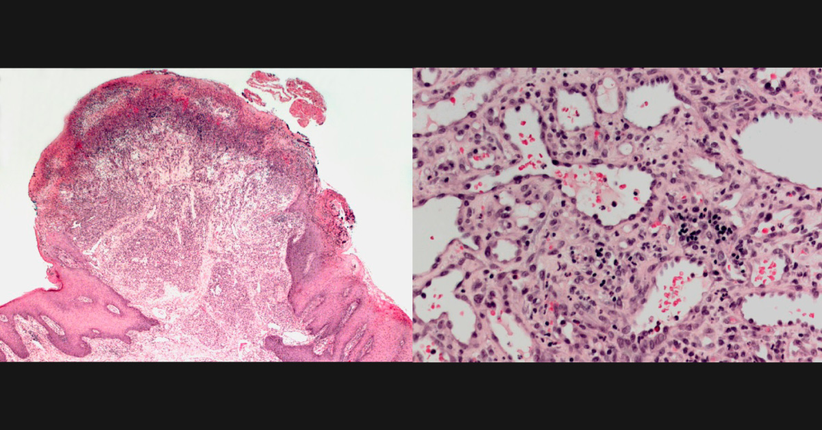 79-year-old Male with Painful Ulceration
