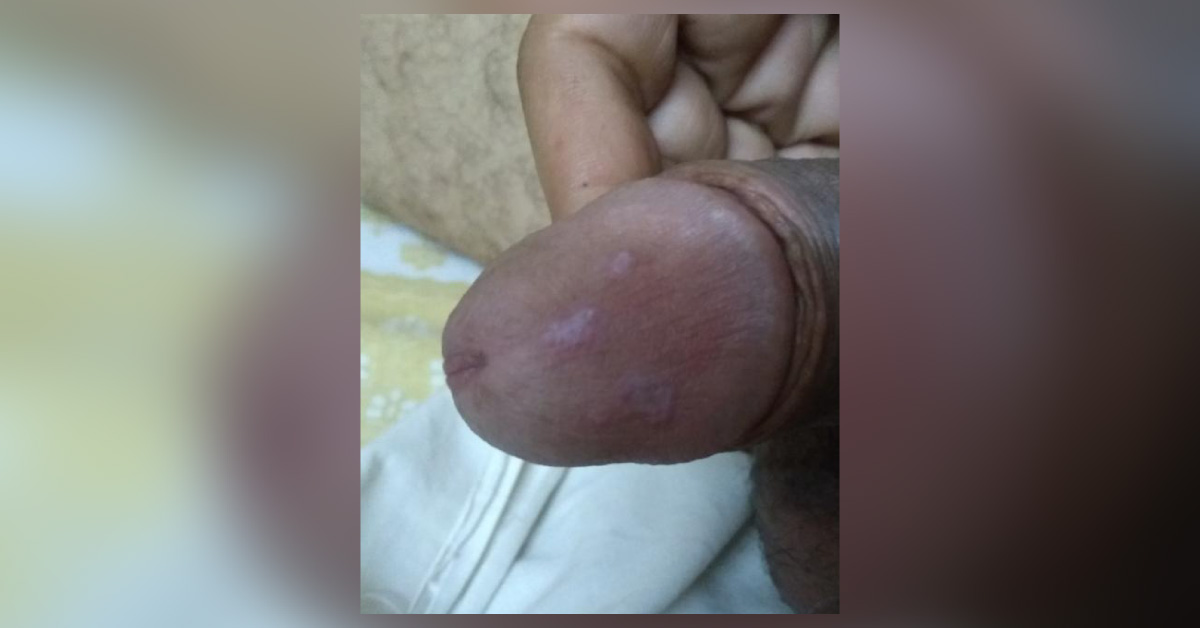 Macules Over The Glans Penis