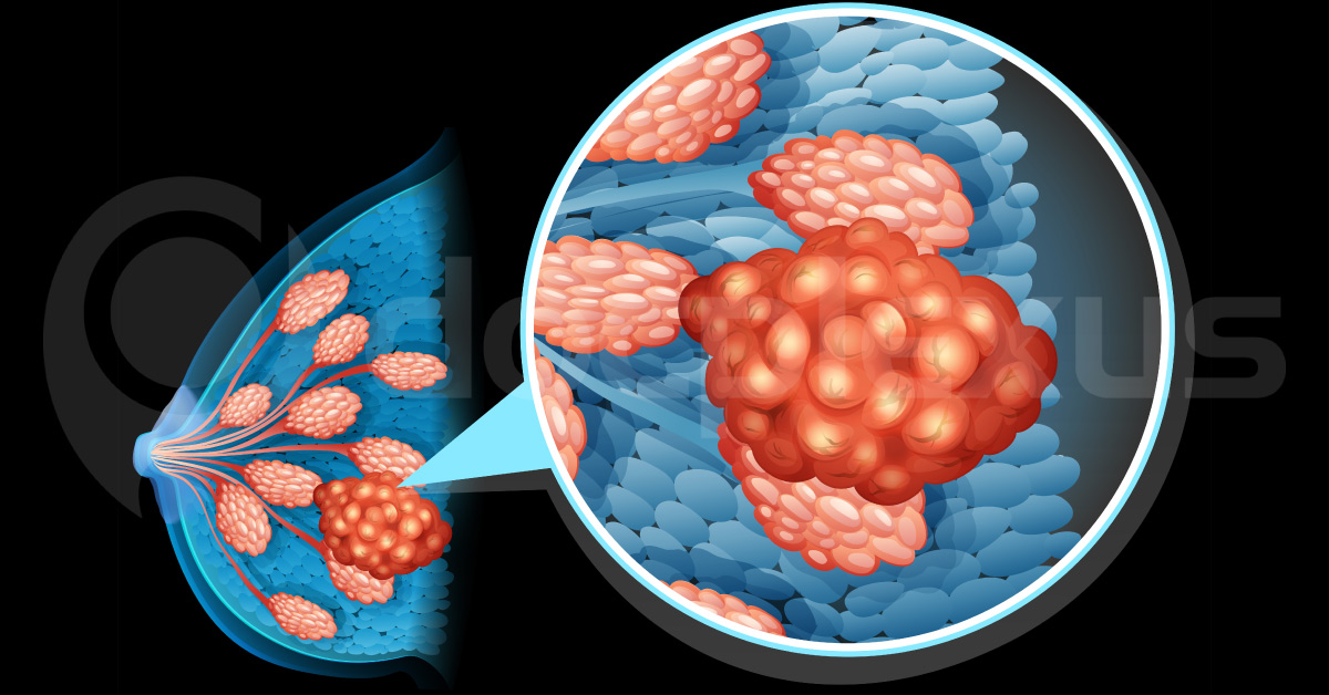 Seventy Percent Breast Cancer Patients Don’t Need Chemotherapy