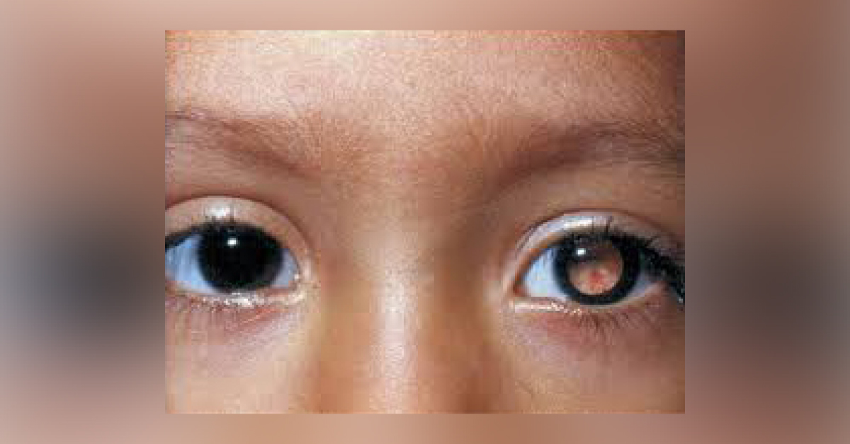 Kids Suffering More With Eye Cancer As Compared To Adults
