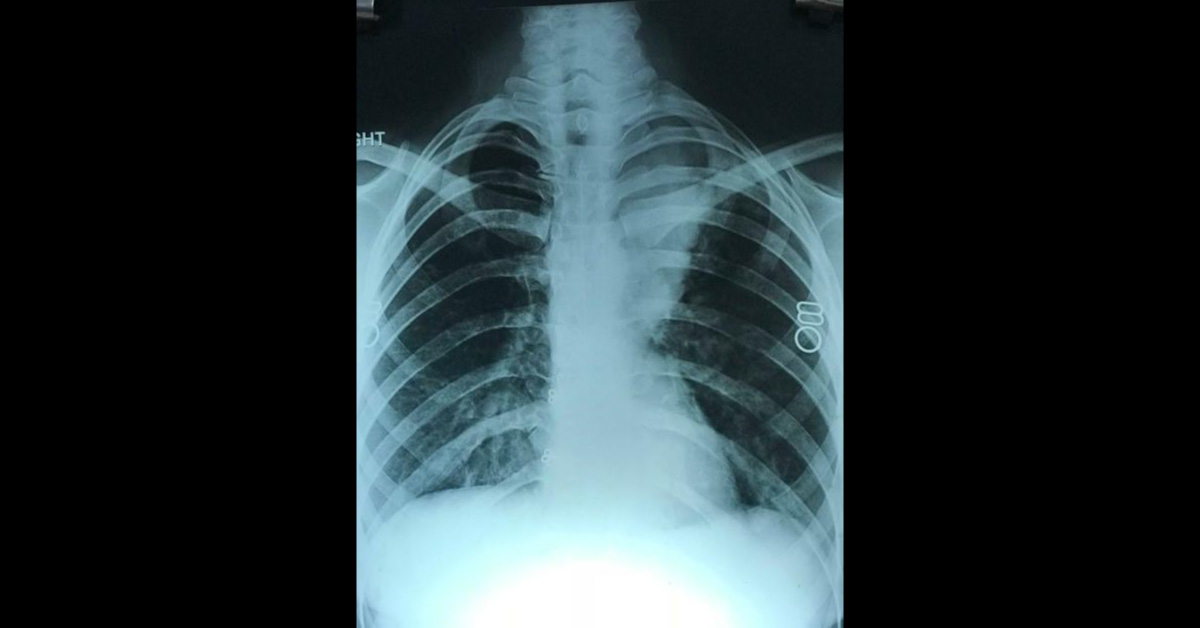 Provisional Diagnosis Of This X Ray?