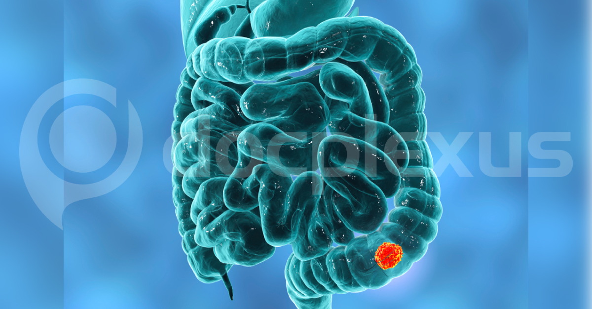 Metformin Decreases Colorectal Cancer Risk