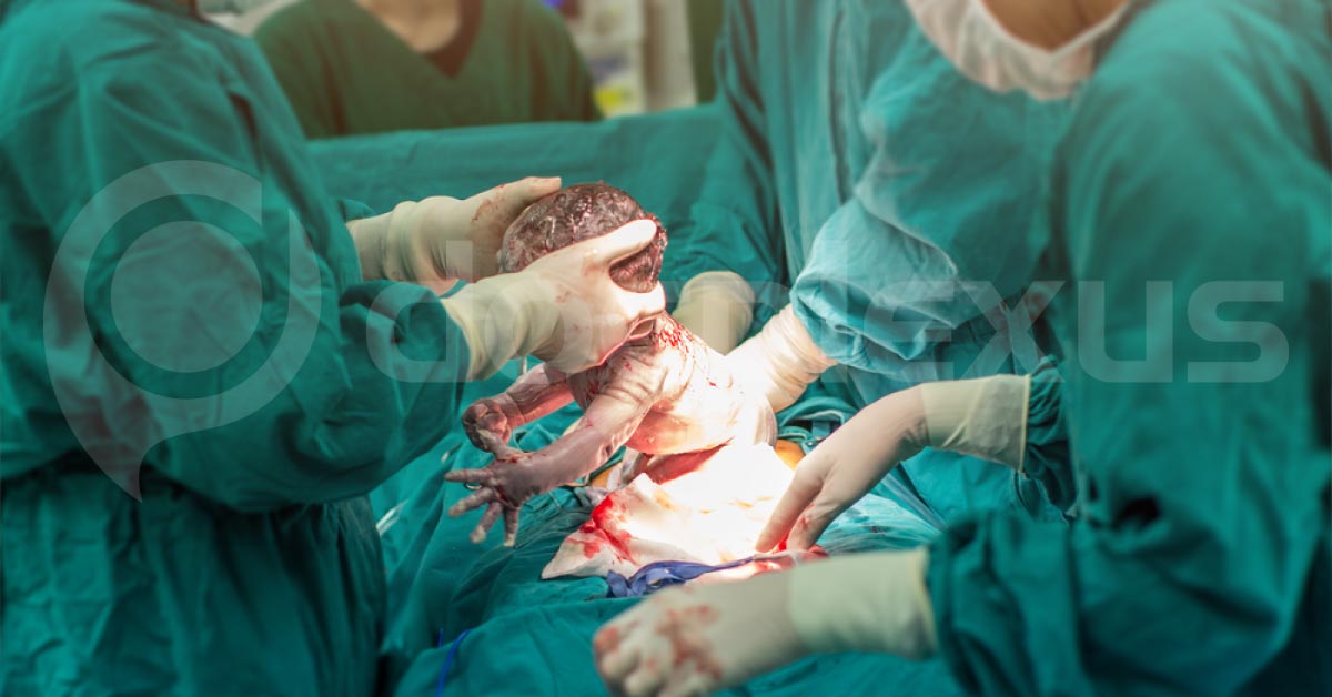 Cesarean Delivery Not Associated With Obesity In Offsprings As Stated Previous Studies