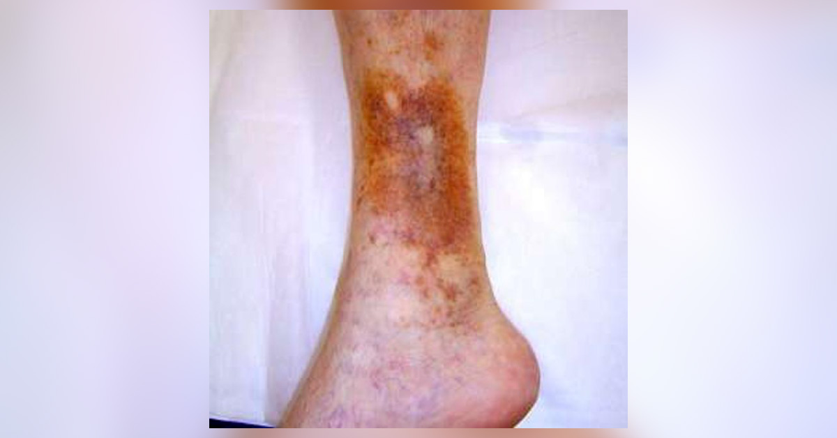 Silver Dressing Is The Best For Healing Of Venous Ulcer