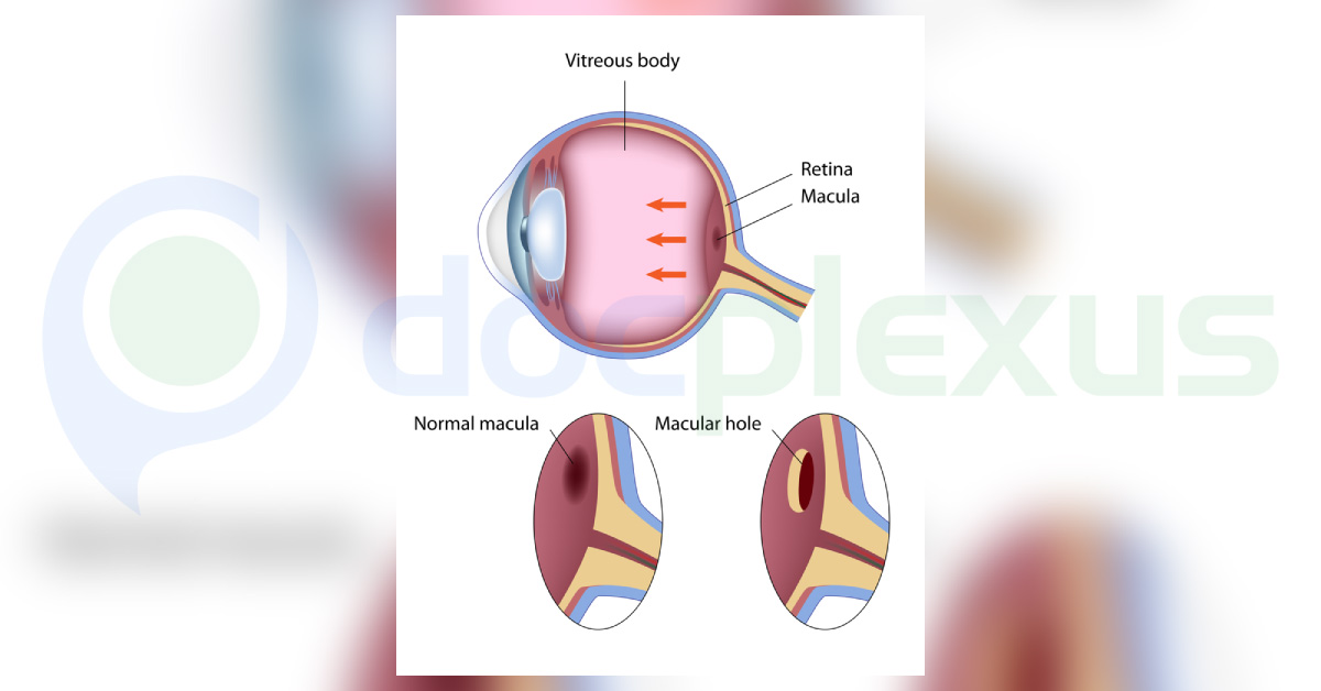 Review On Macular Disorders