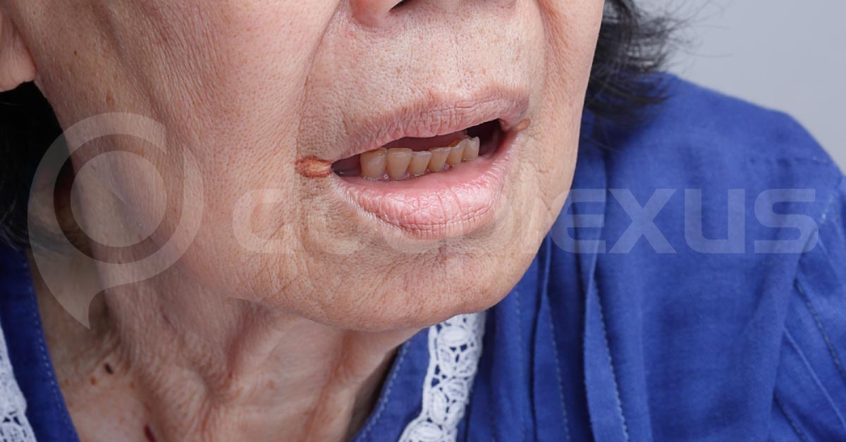 Long Standing Rash Around The Mouth