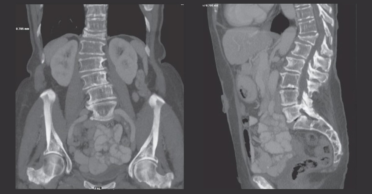 Sudden Onset Of Back Pain