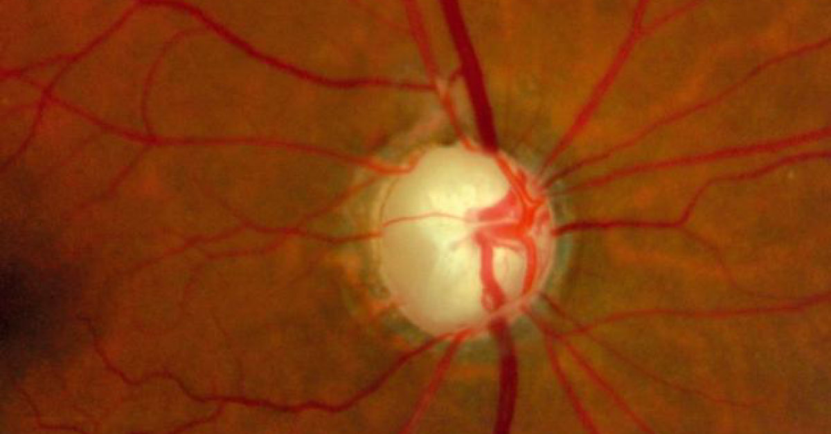 Brief Scenario Of Contrast Sensitivity Glaucoma