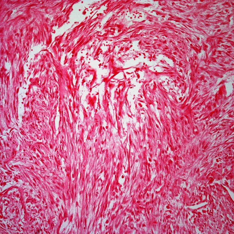 A Woman With Right Forearm Lesion