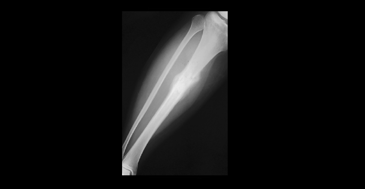 What Type Of Fracture Is This?