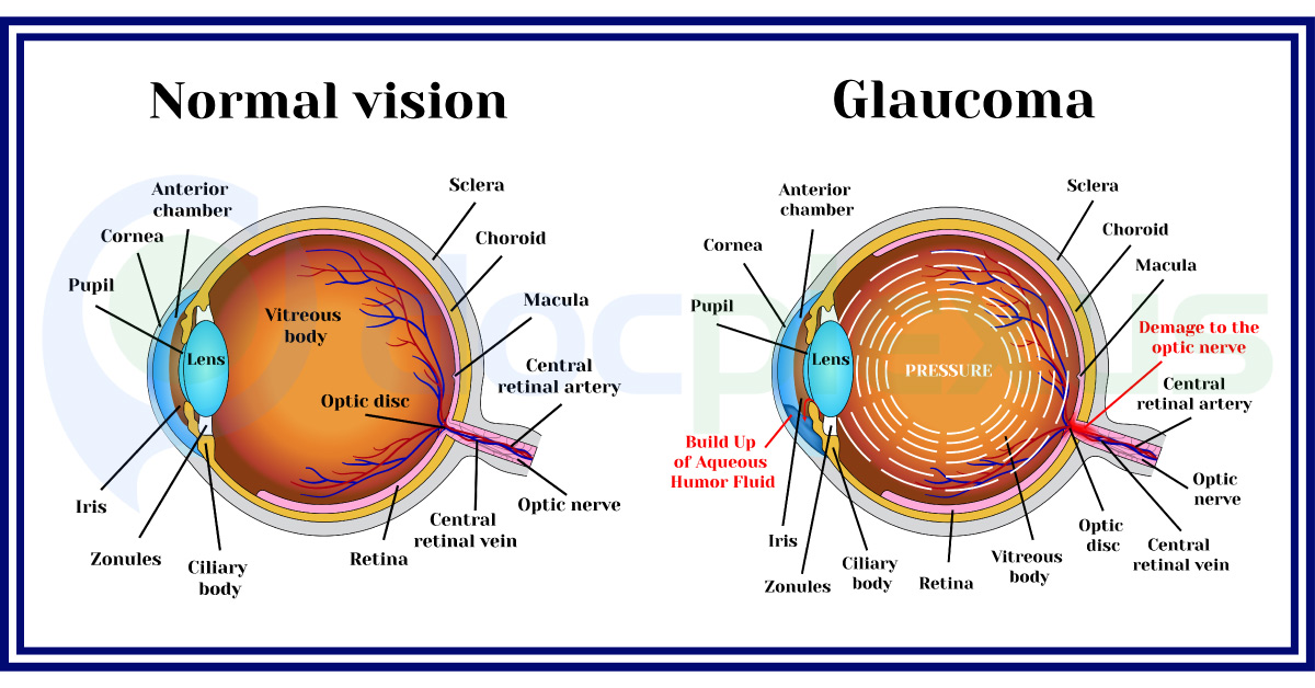 Current Status Of Glaucoma Surgeon