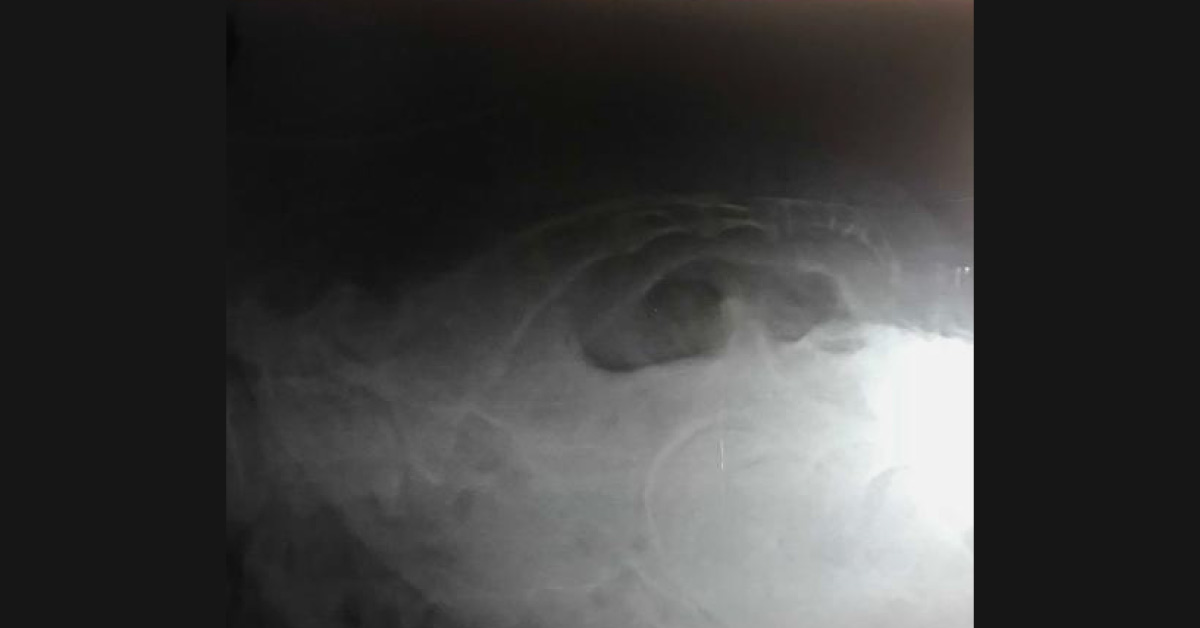 How To Confirm The Coccygeal Fracture?