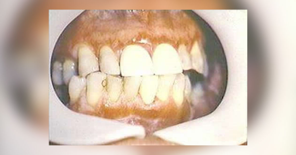 A 30-year-old Man’s Routine Dental Examination