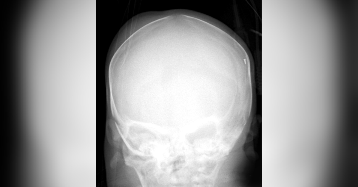 Case of a Newborn with a Bump on the Head Following a Difficult Delivery