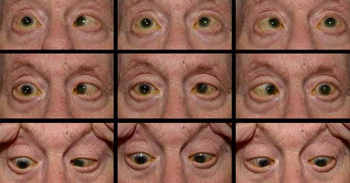 Identify The Ophthalmic Condition