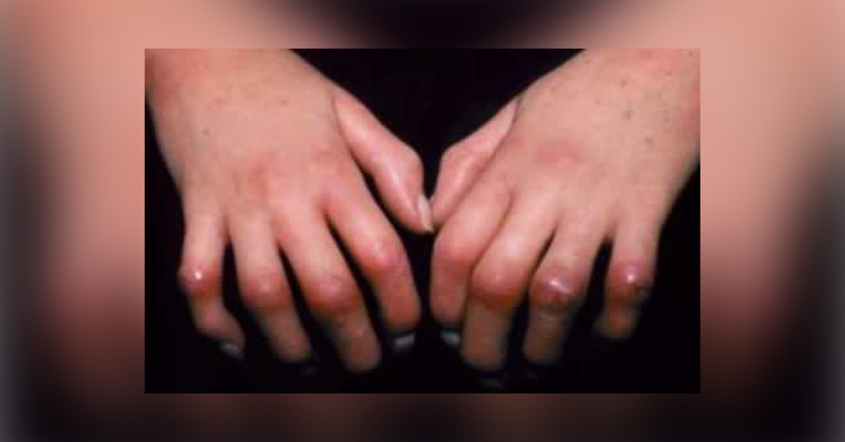 Lenabasum: A New Medicine For Cutaneous Sclerosis