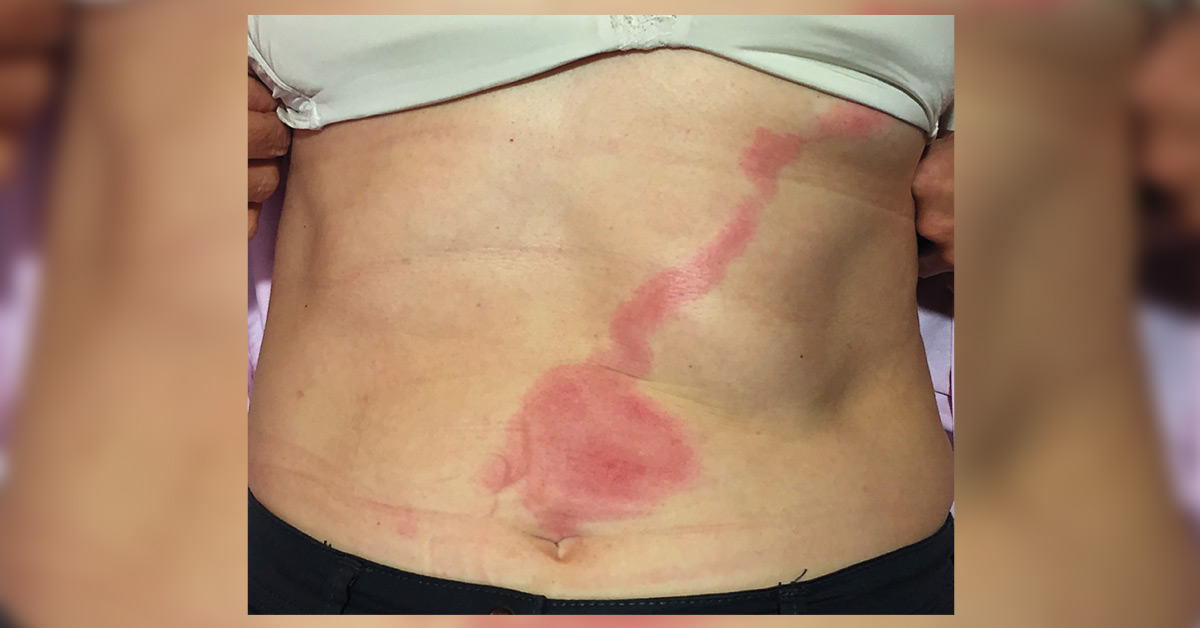 Lesion On Abdomen